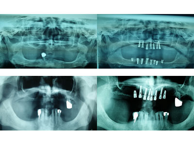 DENTAL IMPLANT Dental orthotics Belgrade - Photo 10
