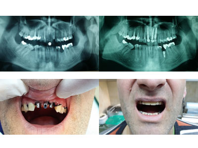 DENTAL IMPLANT Dental orthotics Belgrade - Photo 12