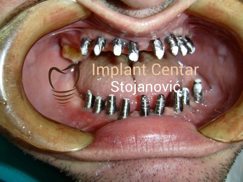 BRANISLAV STOJANOVIC - IMPLANT CENTER Dental surgery Belgrade - Photo 10