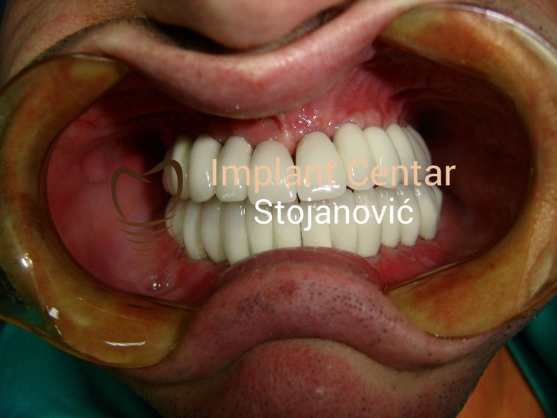 BRANISLAV STOJANOVIC - IMPLANT CENTER Dental surgery Belgrade - Photo 11